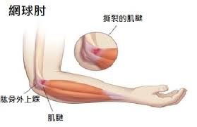 網球肘